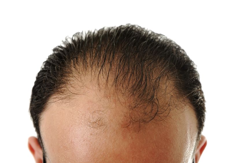 Hair Loss Treatments Essex Hair Salons