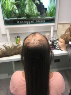 Hair-replacement-Hair-Loss-Treatments-Essex-1