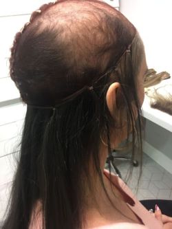 Hair-replacement-Hair-Loss-Treatments-Essex-2